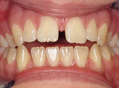 Invisalign 1